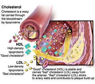 Cholesterol in the heart arteries